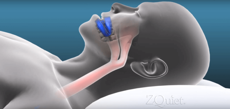 illustration showing how to use ZQuiet anti-snoring mouthpiece