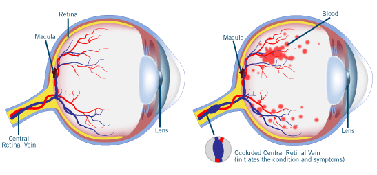 retinal vein occlusion